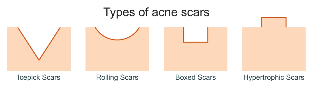 Acne scar remedies for black skin