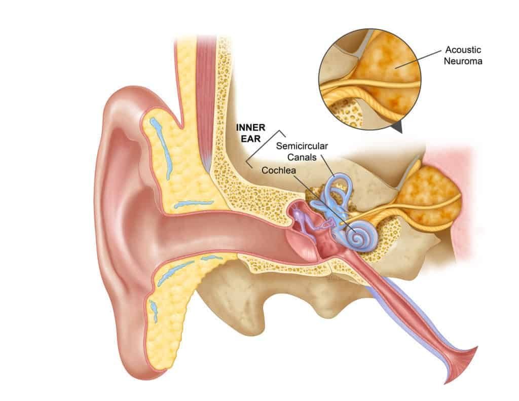 AcousticNeuroma