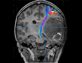 Brain Metastases 1