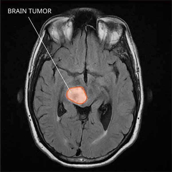 Glioma