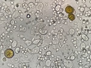 Cholesterol Crystals In The Urine