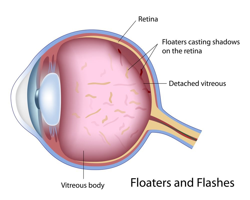 Symptoms of Eye Floaters