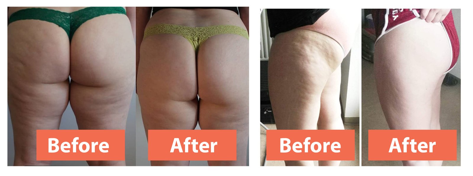 My Cellulite Solution results
